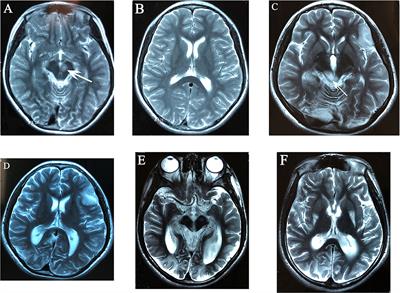 MELAS/LS Overlap Syndrome Associated With Mitochondrial DNA Mutations: Clinical, Genetic, and Radiological Studies